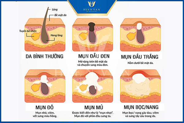 các loại mụn khi dậy thì