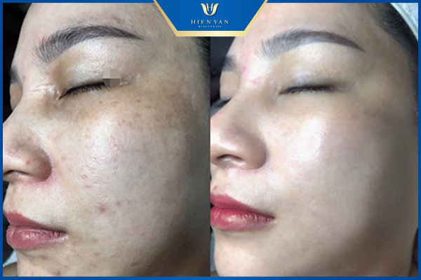 công dụng của lăn kim