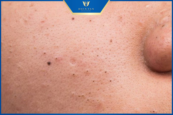 lỗ chân lông to trên mặt