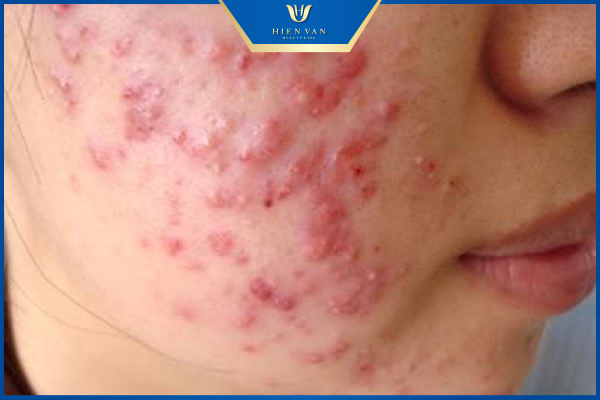 mụn ở tuổi dậy thì