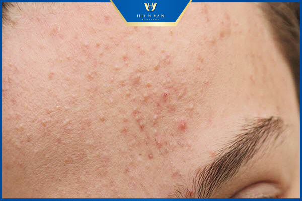 mụn tuổi dậy thì