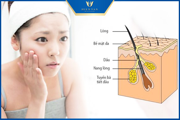 vì sao lỗ chân lông to