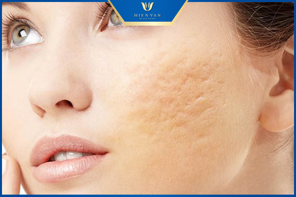 PRP trị sẹo rỗ