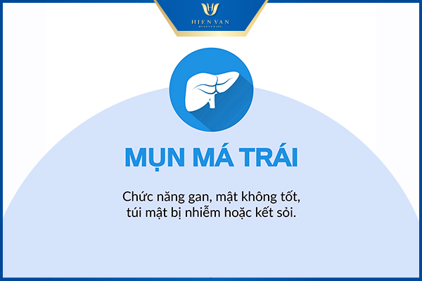 vị trí mụn trên mặt nói lên điều gì