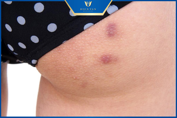 vị trí mọc mụn