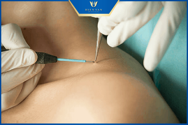 Đốt mụn thịt bằng điện