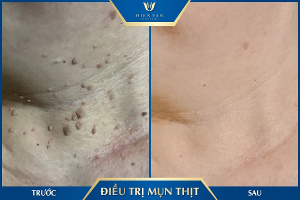 Laser pixel trị mụn thịt