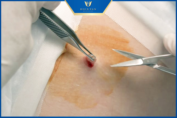 Mụn thịt có trị được dứt điểm không?