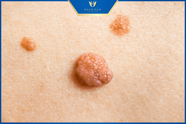 Mụn thịt là gì