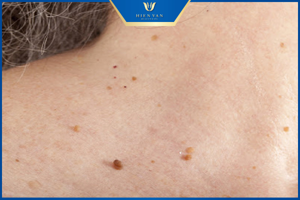 Mụn thịt ở cổ có tự hết được không?