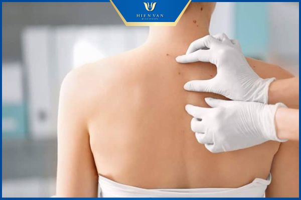 Nguyên nhân gây mụn thịt ở cổ