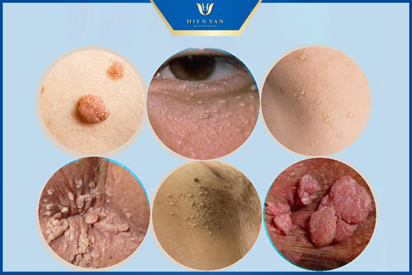 nhận biết mụn thịt ở cổ