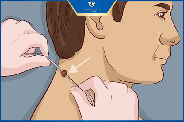 Thắt bằng chỉ phẫu thuật