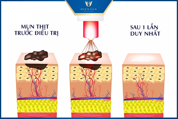 Ưu điểm của Laser Pixel Co2