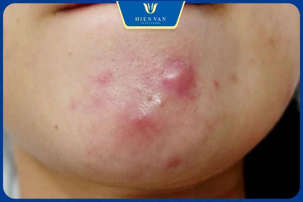 Pixel Master điều trị mụn nang hiệu quả