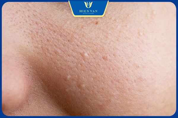 Pixel điều trị mụn tắc nghẽn tuyến dầu