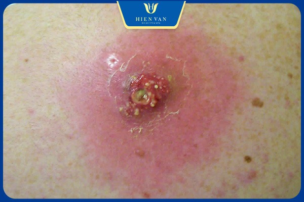 Pixel điều trị mụn viêm tụ cầu