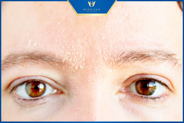 ai bị viêm da tiết bã