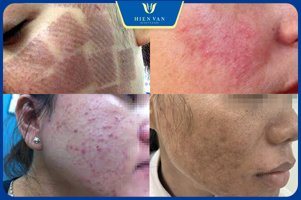 Biến chứng khi trị sẹo bằng laser kém chất lượng