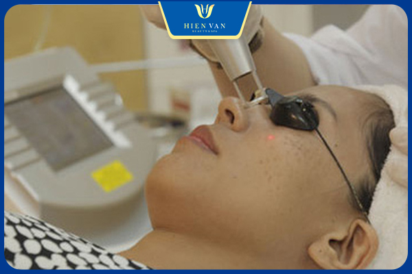trị sẹo rỗ bằng laser kém chất lượng