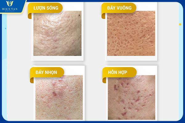 Các loại sẹo có thể trị bằng Pixel