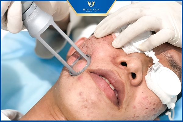 Cơ chế điều trị sẹo của Laser pixel