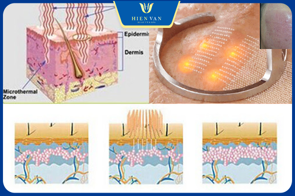 Laser Pixel C02 điều trị sẹo hiệu quả