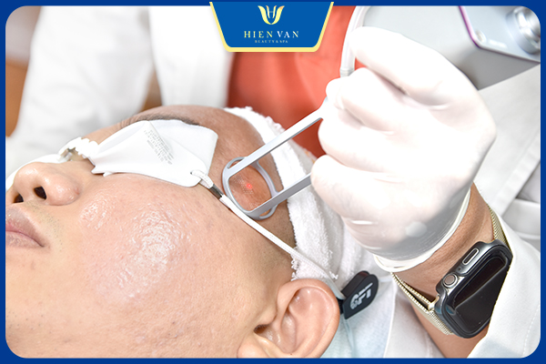 Cơ chế hoạt động của Laser Pixel C02