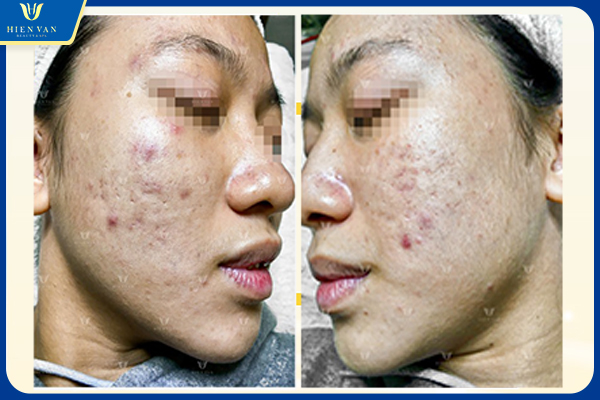 Da có thể nổi một vài nốt mụn sau khi laser