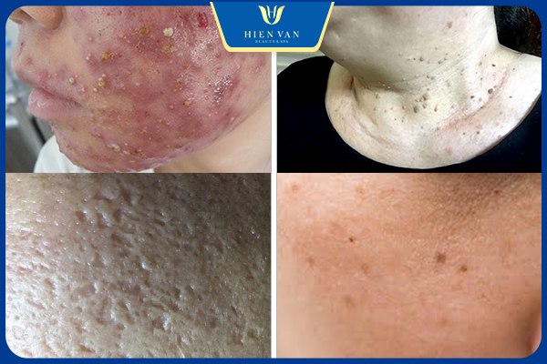 Laser Pixel điều trị nhiều bệnh lý da