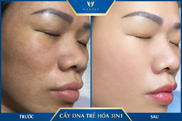 Trẻ hóa da