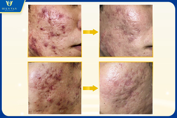 Hệ miễn dịch quyết định hiệu quả trị sẹo rỗ