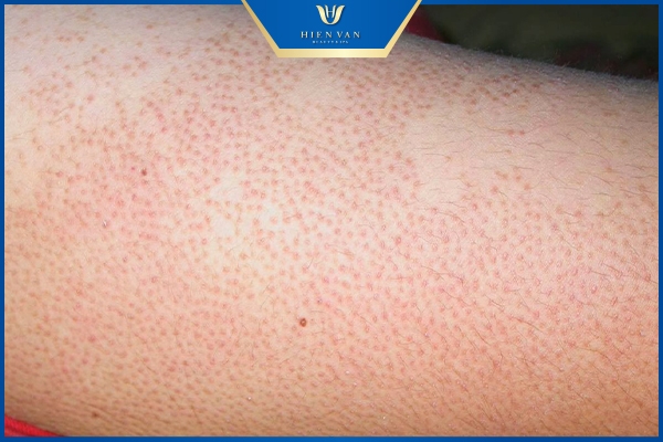 keratosis pilaris là gì