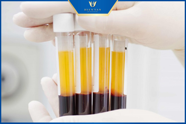 phương pháp prp là gì 