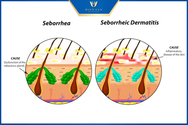 seborrheic dermatitis là gì