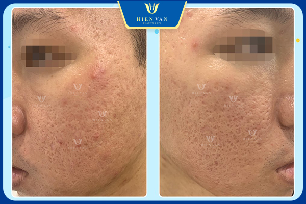 Yếu tố quyết định hiệu quả trị sẹo rỗ