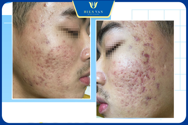 Những yếu tố quyết định hiệu quả trị sẹo rỗ