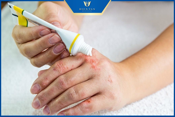 viêm da dầu có chữa khỏi được không 