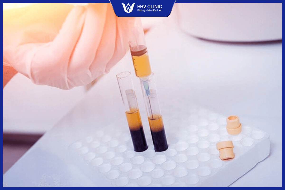 prp bao lâu làm một lần