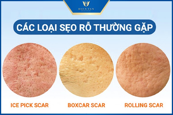các loại sẹo