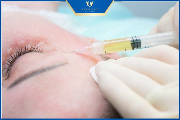 Mất bao lâu để thấy kết quả điều trị bằng tiêm PRP