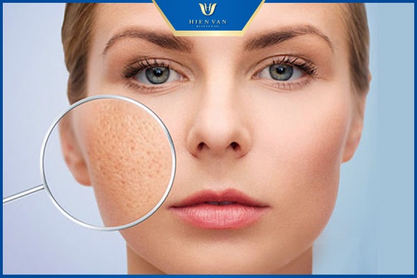 mặt bị rỗ có chữa được không