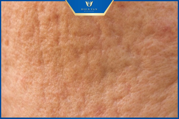 mặt rỗ có chữa được không