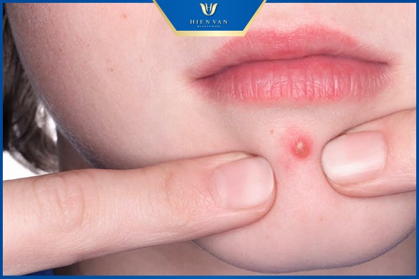 sau khi nặn mụn nên làm gì