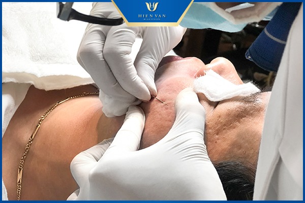 sẹo rỗ có trị đc k