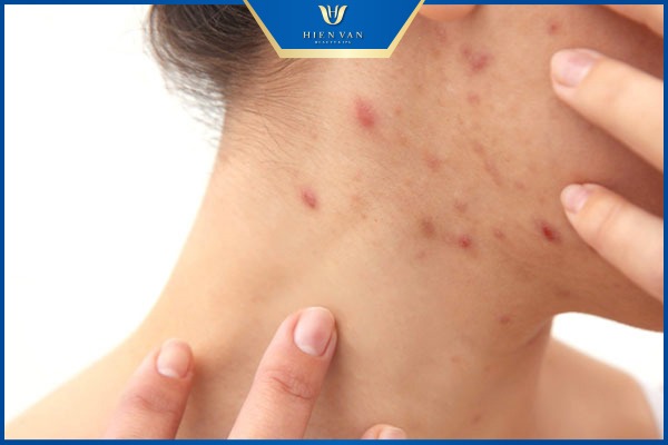 vết thâm mụn có tự hết không