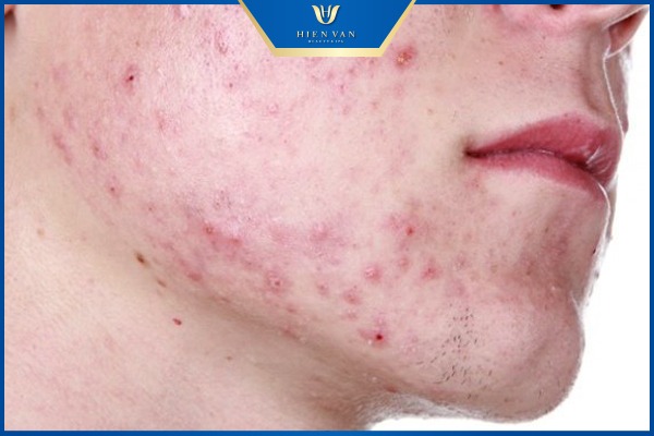 vết thâm sau nặn mụn