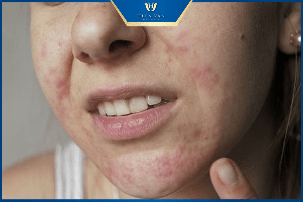 cách chăm sóc da sau peel