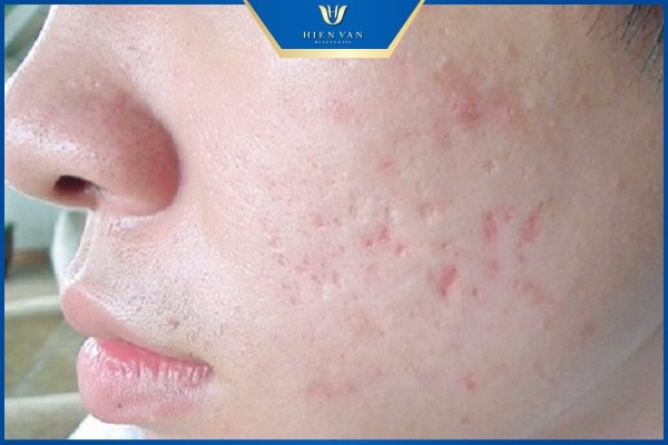 cách trị sẹo lõm trên mặt