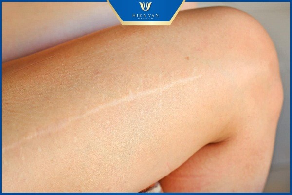 cách trị sẹo trắng